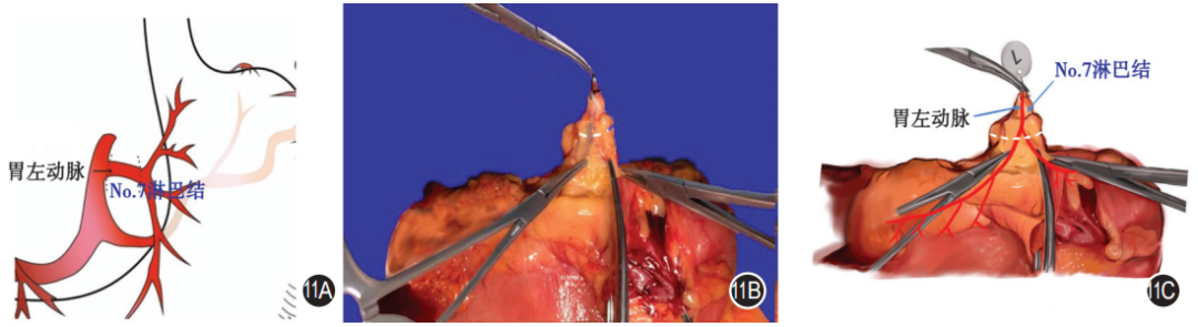 大体标本是什么【指南与共识】胃癌根治术标本的规范化外科处理中国专家共识（2022版）_https://www.jmylbn.com_新闻资讯_第11张