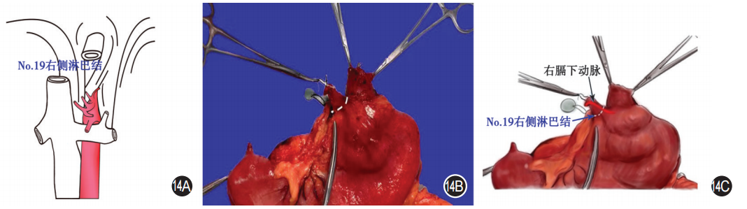 大体标本是什么【指南与共识】胃癌根治术标本的规范化外科处理中国专家共识（2022版）_https://www.jmylbn.com_新闻资讯_第14张