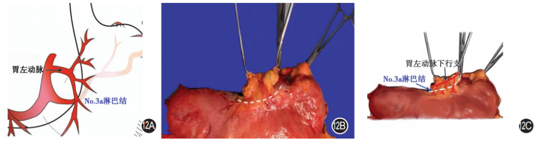 大体标本是什么【指南与共识】胃癌根治术标本的规范化外科处理中国专家共识（2022版）_https://www.jmylbn.com_新闻资讯_第12张