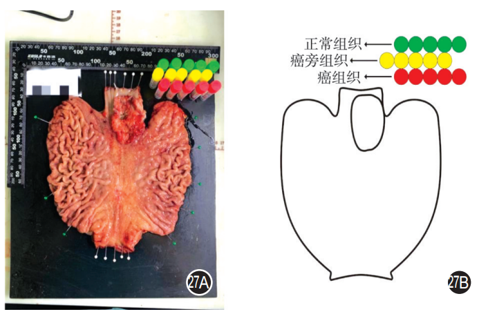 大体标本是什么【指南与共识】胃癌根治术标本的规范化外科处理中国专家共识（2022版）_https://www.jmylbn.com_新闻资讯_第27张