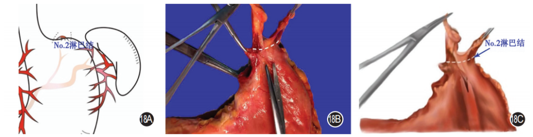 大体标本是什么【指南与共识】胃癌根治术标本的规范化外科处理中国专家共识（2022版）_https://www.jmylbn.com_新闻资讯_第18张