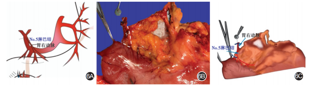 大体标本是什么【指南与共识】胃癌根治术标本的规范化外科处理中国专家共识（2022版）_https://www.jmylbn.com_新闻资讯_第6张