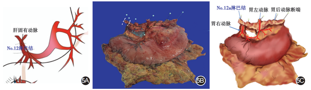 大体标本是什么【指南与共识】胃癌根治术标本的规范化外科处理中国专家共识（2022版）_https://www.jmylbn.com_新闻资讯_第5张