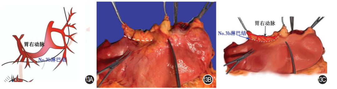大体标本是什么【指南与共识】胃癌根治术标本的规范化外科处理中国专家共识（2022版）_https://www.jmylbn.com_新闻资讯_第13张