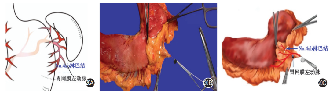 大体标本是什么【指南与共识】胃癌根治术标本的规范化外科处理中国专家共识（2022版）_https://www.jmylbn.com_新闻资讯_第20张