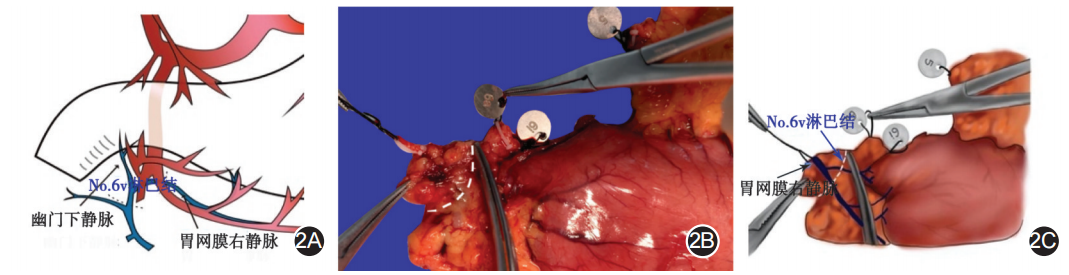 大体标本是什么【指南与共识】胃癌根治术标本的规范化外科处理中国专家共识（2022版）_https://www.jmylbn.com_新闻资讯_第2张