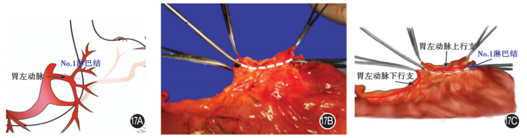 大体标本是什么【指南与共识】胃癌根治术标本的规范化外科处理中国专家共识（2022版）_https://www.jmylbn.com_新闻资讯_第17张