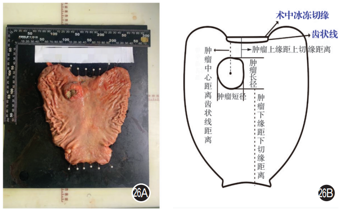 大体标本是什么【指南与共识】胃癌根治术标本的规范化外科处理中国专家共识（2022版）_https://www.jmylbn.com_新闻资讯_第26张