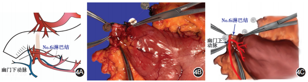 大体标本是什么【指南与共识】胃癌根治术标本的规范化外科处理中国专家共识（2022版）_https://www.jmylbn.com_新闻资讯_第4张