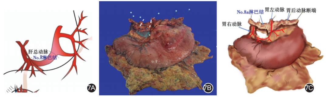 大体标本是什么【指南与共识】胃癌根治术标本的规范化外科处理中国专家共识（2022版）_https://www.jmylbn.com_新闻资讯_第7张