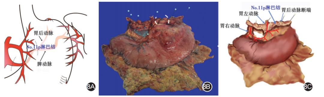 大体标本是什么【指南与共识】胃癌根治术标本的规范化外科处理中国专家共识（2022版）_https://www.jmylbn.com_新闻资讯_第8张