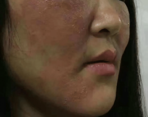 什么是光电治疗光电联合治疗——敏感肌皮肤的全新解决方案_https://www.jmylbn.com_新闻资讯_第9张