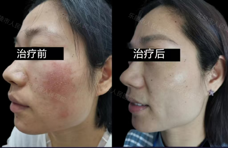 什么是光电治疗光电联合治疗——敏感肌皮肤的全新解决方案_https://www.jmylbn.com_新闻资讯_第12张