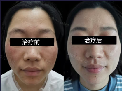 什么是光电治疗光电联合治疗——敏感肌皮肤的全新解决方案_https://www.jmylbn.com_新闻资讯_第11张