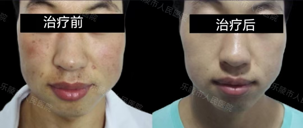 什么是光电治疗光电联合治疗——敏感肌皮肤的全新解决方案_https://www.jmylbn.com_新闻资讯_第13张