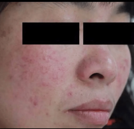 什么是光电治疗光电联合治疗——敏感肌皮肤的全新解决方案_https://www.jmylbn.com_新闻资讯_第8张