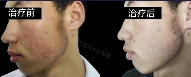 什么是光电治疗光电联合治疗——敏感肌皮肤的全新解决方案_https://www.jmylbn.com_新闻资讯_第14张