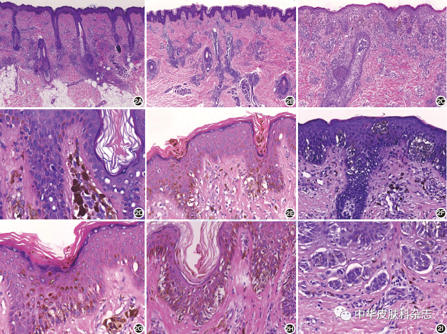 图2婴幼儿先天性色素痣常见组织病理特征2a:痣细胞以毛囊皮脂腺为中心