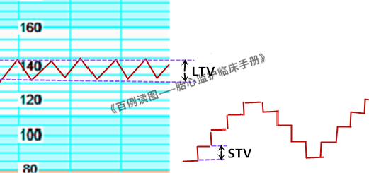 胎心监护vd是什么意思胎心监护如何评估？变异减少时又该如何判读？附病例、图表详细解读＞_https://www.jmylbn.com_新闻资讯_第5张