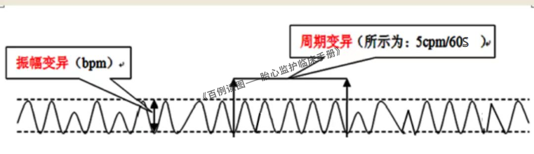 胎心监护vd是什么意思胎心监护如何评估？变异减少时又该如何判读？附病例、图表详细解读＞_https://www.jmylbn.com_新闻资讯_第4张