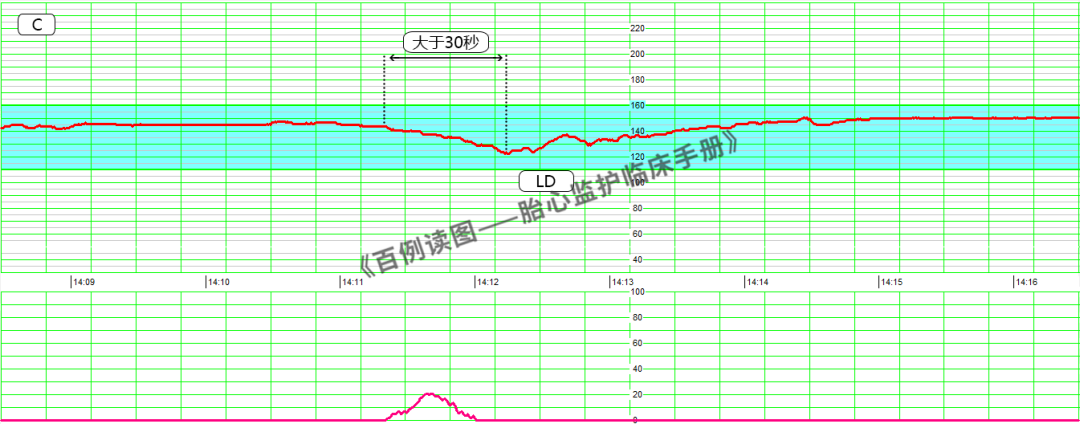 胎心监护vd是什么意思胎心监护如何评估？变异减少时又该如何判读？附病例、图表详细解读＞_https://www.jmylbn.com_新闻资讯_第13张