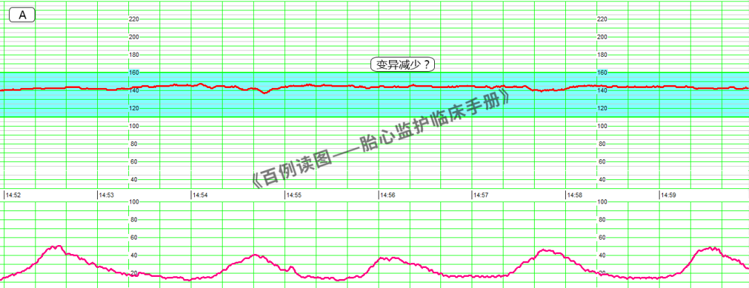 胎心监护vd是什么意思胎心监护如何评估？变异减少时又该如何判读？附病例、图表详细解读＞_https://www.jmylbn.com_新闻资讯_第9张