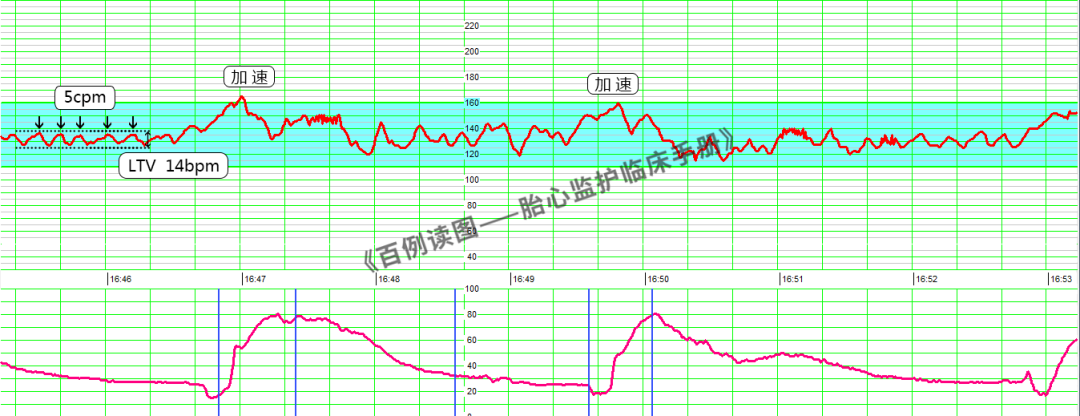 胎心监护vd是什么意思胎心监护如何评估？变异减少时又该如何判读？附病例、图表详细解读＞_https://www.jmylbn.com_新闻资讯_第7张