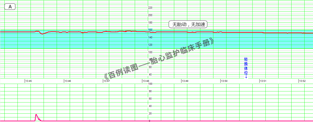 胎心监护vd是什么意思胎心监护如何评估？变异减少时又该如何判读？附病例、图表详细解读＞_https://www.jmylbn.com_新闻资讯_第11张