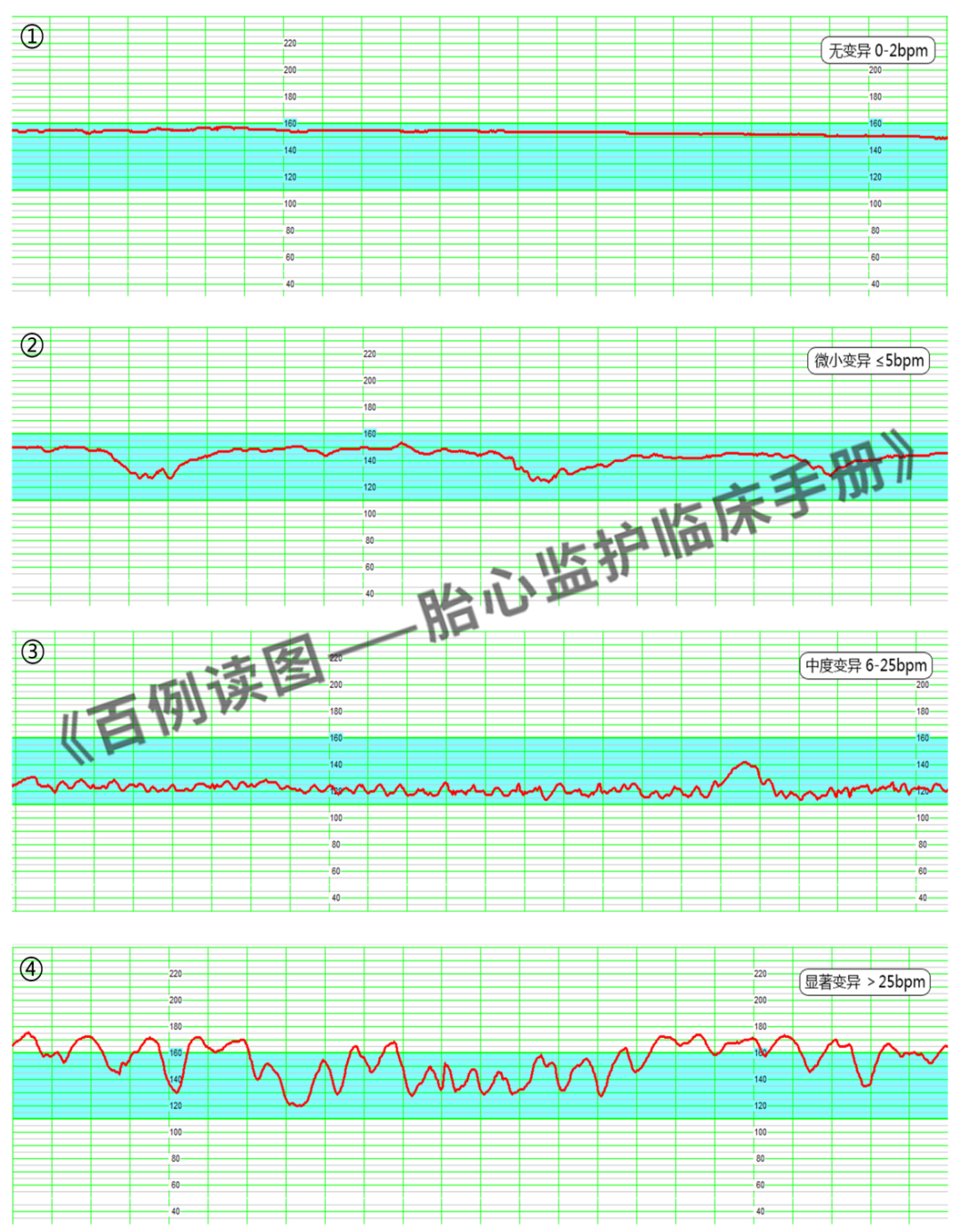 胎心监护vd是什么意思胎心监护如何评估？变异减少时又该如何判读？附病例、图表详细解读＞_https://www.jmylbn.com_新闻资讯_第6张