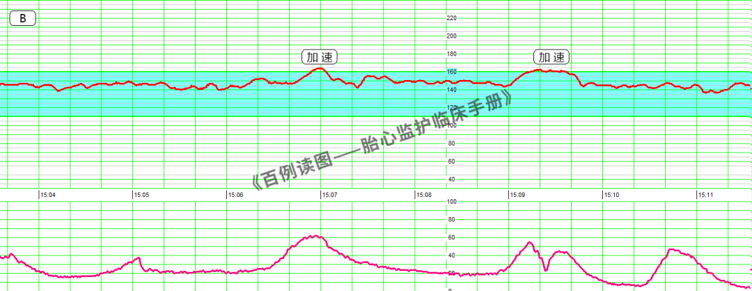 胎心监护vd是什么意思胎心监护如何评估？变异减少时又该如何判读？附病例、图表详细解读＞_https://www.jmylbn.com_新闻资讯_第10张