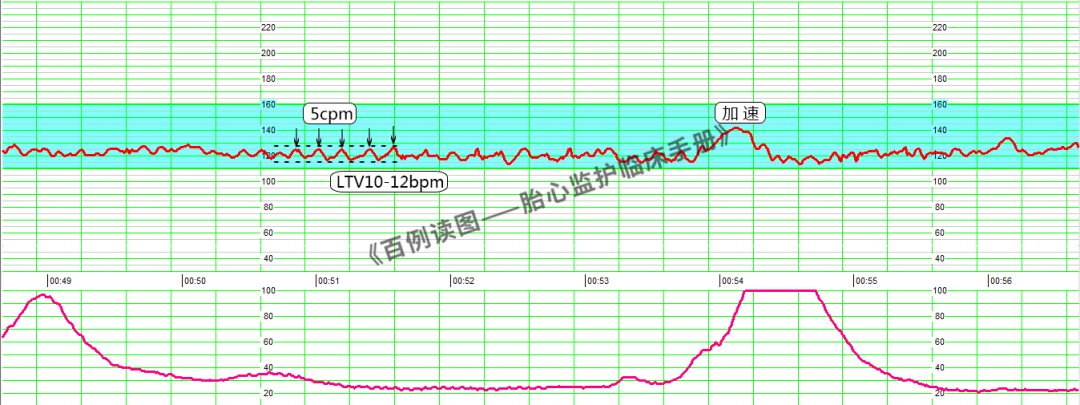 胎心监护vd是什么意思胎心监护如何评估？变异减少时又该如何判读？附病例、图表详细解读＞_https://www.jmylbn.com_新闻资讯_第8张