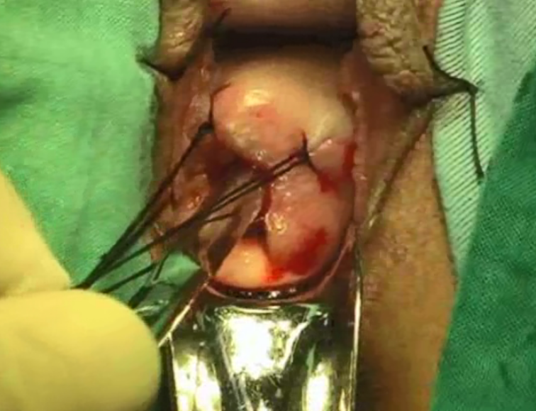 怎么使用妇科探针妇产科普丨警惕！小小的宫颈锥切，也可能造成严重并发症，别踩这4个坑！_https://www.jmylbn.com_新闻资讯_第2张