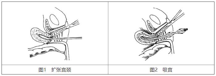 宫颈扩张棒怎么放置基础技能：5个常见妇科小手术，操作要点、注意事项你知道吗？_https://www.jmylbn.com_新闻资讯_第5张