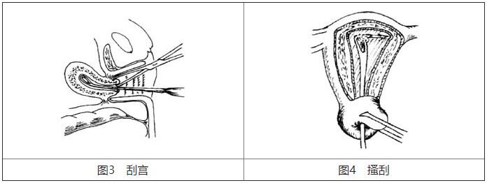 宫颈扩张棒怎么放置基础技能：5个常见妇科小手术，操作要点、注意事项你知道吗？_https://www.jmylbn.com_新闻资讯_第6张