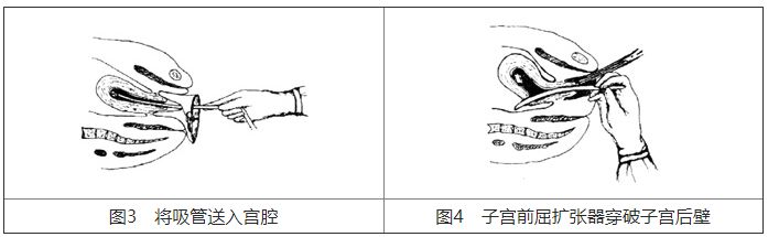 宫颈扩张棒怎么放置基础技能：5个常见妇科小手术，操作要点、注意事项你知道吗？_https://www.jmylbn.com_新闻资讯_第4张