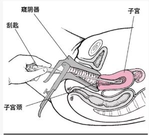 宫颈扩张棒怎么放置基础技能：5个常见妇科小手术，操作要点、注意事项你知道吗？_https://www.jmylbn.com_新闻资讯_第7张