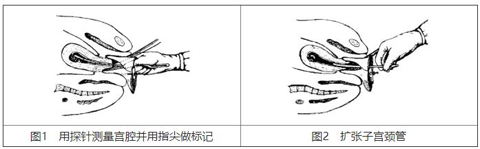 宫颈扩张棒怎么放置基础技能：5个常见妇科小手术，操作要点、注意事项你知道吗？_https://www.jmylbn.com_新闻资讯_第3张