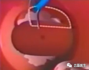 电切环怎么连接导线宫颈锥切术与LEEP术，优缺点是什么？哪个效果更好？（附具体操作方法）_https://www.jmylbn.com_新闻资讯_第8张