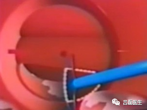 电切环怎么连接导线宫颈锥切术与LEEP术，优缺点是什么？哪个效果更好？（附具体操作方法）_https://www.jmylbn.com_新闻资讯_第9张