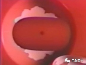 电切环怎么连接导线宫颈锥切术与LEEP术，优缺点是什么？哪个效果更好？（附具体操作方法）_https://www.jmylbn.com_新闻资讯_第7张