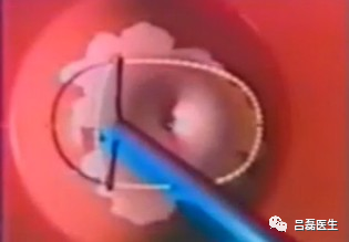 电切环怎么连接导线宫颈锥切术与LEEP术，优缺点是什么？哪个效果更好？（附具体操作方法）_https://www.jmylbn.com_新闻资讯_第6张