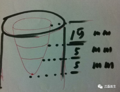 电切环怎么连接导线宫颈锥切术与LEEP术，优缺点是什么？哪个效果更好？（附具体操作方法）_https://www.jmylbn.com_新闻资讯_第12张