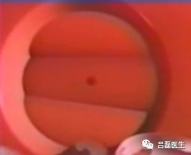 电切环怎么连接导线宫颈锥切术与LEEP术，优缺点是什么？哪个效果更好？（附具体操作方法）_https://www.jmylbn.com_新闻资讯_第10张