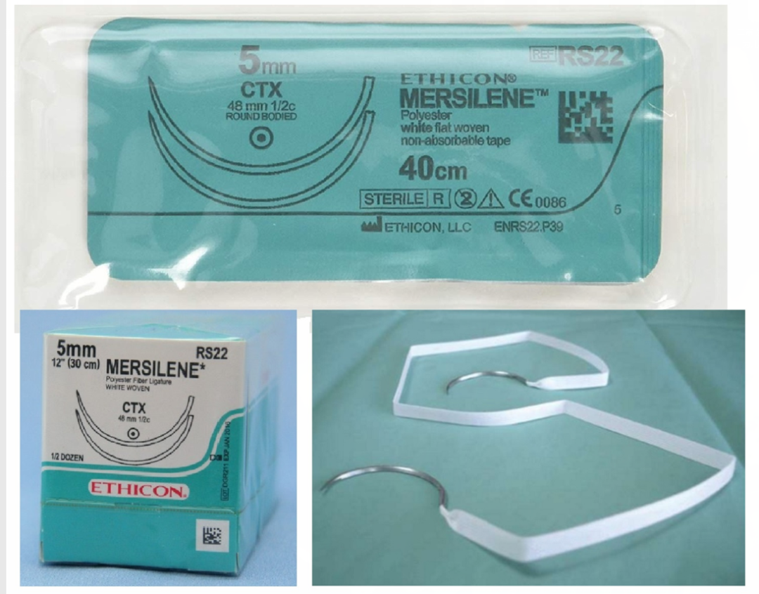 子宫拉钩怎么用经阴道宫颈环扎术保姆级教学：4大术式分步骤带图讲解，值得收藏！_https://www.jmylbn.com_新闻资讯_第5张