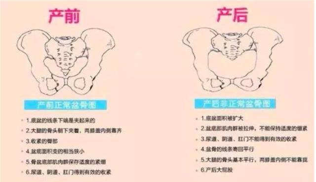 产后怎么康复治疗盆底康复治疗方案汇总_https://www.jmylbn.com_新闻资讯_第2张