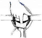 宫剪怎么样收藏！产科经典手术“子宫下段剖宫产术”步骤，图文详解！_https://www.jmylbn.com_新闻资讯_第5张