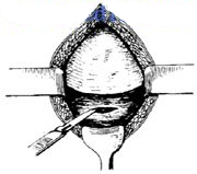 宫剪怎么样收藏！产科经典手术“子宫下段剖宫产术”步骤，图文详解！_https://www.jmylbn.com_新闻资讯_第6张