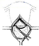 宫剪怎么样收藏！产科经典手术“子宫下段剖宫产术”步骤，图文详解！_https://www.jmylbn.com_新闻资讯_第8张