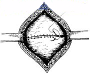 宫剪怎么样收藏！产科经典手术“子宫下段剖宫产术”步骤，图文详解！_https://www.jmylbn.com_新闻资讯_第17张