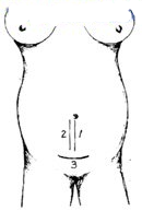 宫剪怎么样收藏！产科经典手术“子宫下段剖宫产术”步骤，图文详解！_https://www.jmylbn.com_新闻资讯_第3张